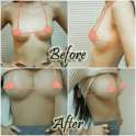asian breast implants before after.jpg