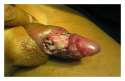 maggot-infested wound of the penis.jpg