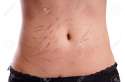 33451078-female-tummy-with-scars-from-deliberate-self-harm-Stock-Photo.jpg