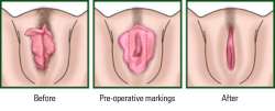 labiaplasty-surical-procedure.jpg