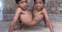 Conjoined-twins-Shivnath-and-Shivram.jpg