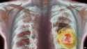 _83308741_m1340336-coloured_x-ray_showing_lung_cancer-spl.jpg