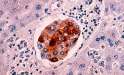 breast-cancer-cells-012.jpg