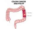 colon-cancer-diagram.jpg