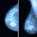 xray-breast-cancer.jpg