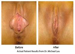 vaginal-rejuvenation-labiaplasty2.jpg