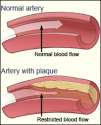 arteriosclerosis-artery-plaque-nature-cure.gif