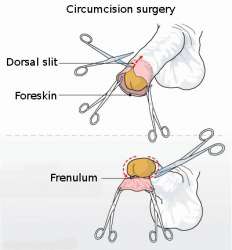 Circumcision_illustration.jpg