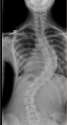 pediatric-scoliosis-x-ray.png