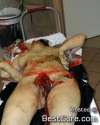 severe-female-genital-mutilation-484x600.jpg