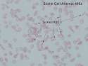 Sickle Cell Anemia-400x-All Labels-08155700 copy.jpg