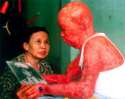 Agent-Orange-dioxin-skin-damage-Vietnam.jpg