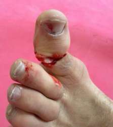 Anthony-Perosh-Broken-Toe-AdamIreland1[2].jpg