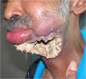 mouthcancer1.jpg