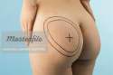 664-06277263em-Naked-buttocks-marked-for-plastic-surgery[1].jpg