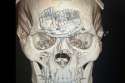 Cyborg-Santos-skull-after-surgery23.jpg