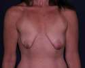 20 Patient with bilateral ptosis and atrophy of the breasts.jpg