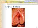 275c8-genital+herpes+female+to+female+transmission_37880.jpg