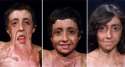 burn-victim-gets-amazing-facial-reconstruction-64450-600x326.jpg