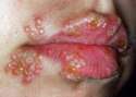 herpes-in-the-mouth.jpg