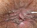 Acuteness-wet-wart-Genital-Wart-Remover-Skin-Tag-Mole-and-Wart-Removal-HPV-kill-Genital-warts.jpg