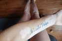 Pay--vitiligo.jpg