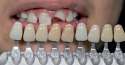 Uskla-ivanje-boje-zuba-u-okviru-fiksnoprotetske-terapije.jpg