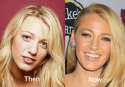 Blake-Lively-Plastic-Surgery-Before-and-After-nose-job[1].jpg