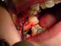 DentalSurgicalExtraction.jpg