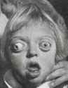 Patient_with_Crouzon_syndrome_(1912).jpg