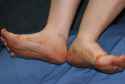 diabetes_foot_problems_s3_vascular.jpg