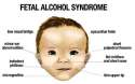 Fetal-Alcohol-Syndrome2.jpg