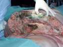 septic cesarean wound on morbidly obese woman.jpg