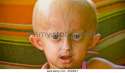 beandri-booysen-who-suffers-from-a-genetic-diseases-called-progeria-bgg6et.jpg