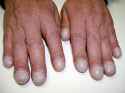 clubbed-fingers-heart-disease-800x800.jpg