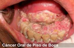 cancer-oral_piso-boca.jpg