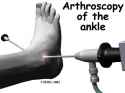 ankle_osteoarthritis_treatment03.jpg